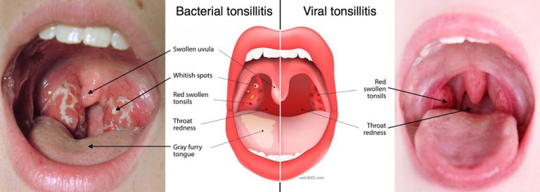 How To Treat Viral Tonsillitis